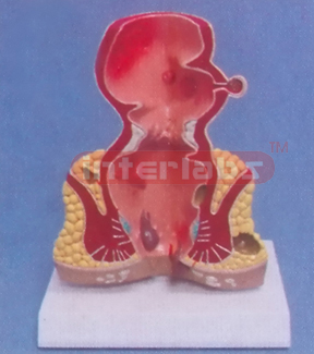 DESK TYPE COMMOM PATHOLOGIES MODEL OF RECTUM